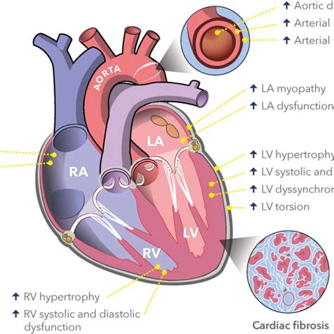 PDF Pathophysiology Of Hypertensive Heart Disease Beyond Left