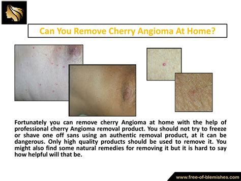 PPT - What Is Cherry Angioma And How To Remove Cherry Angioma At Home PowerPoint Presentation ...