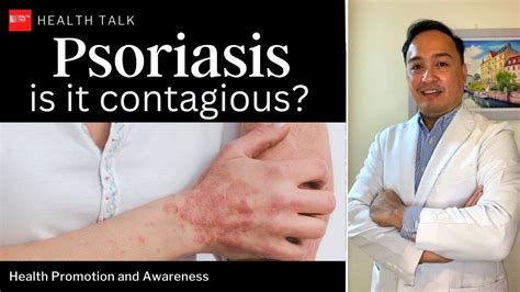 Psoriasis Is It Contagious Causes And Symptoms YouTube