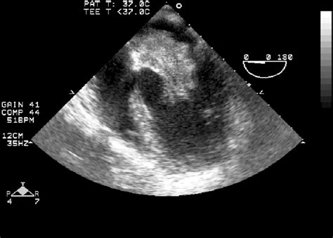 Preoperative Transesophageal Echocardiography Shows A Large Left Atrial Download Scientific