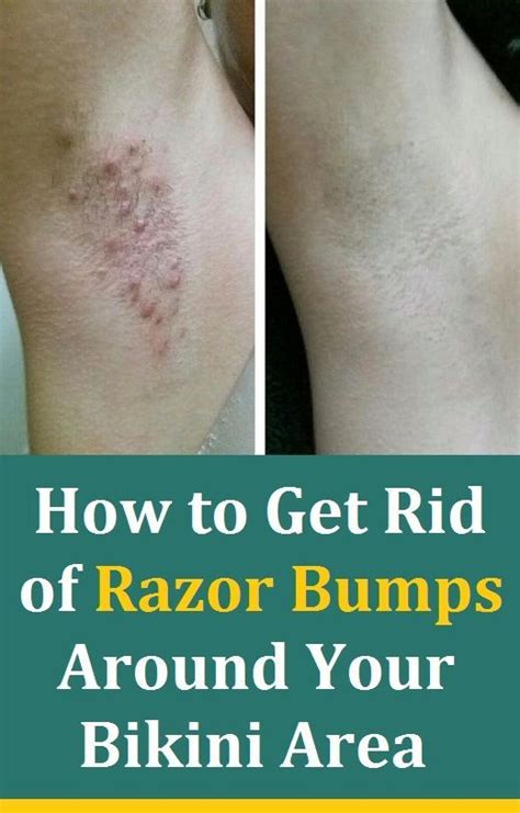 Get Rid Of Razor Burn Overnight