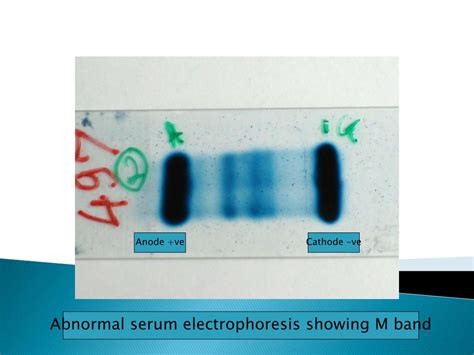 Ppt Serum Protein Electrophoresis Powerpoint Presentation Free