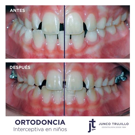 Caso Desviación Mandibular Y Mordida Cruzada Posterior Clínica Dental