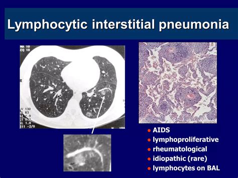 ipf   ipf interstitial lung diseases