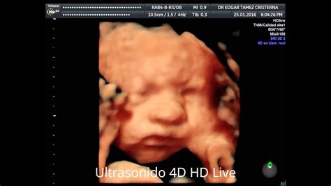 Diferencia entre ultrasonido 4D Convencional/4D HD Live - YouTube