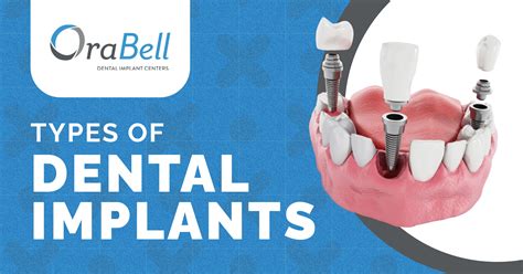 Types of Dental Implants | OraBell