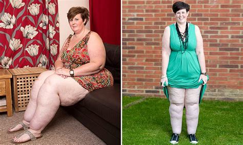 Obese Mother Is Left With Tree Trunk Legs Due To Rare Condition Despite Drastic Weight Loss