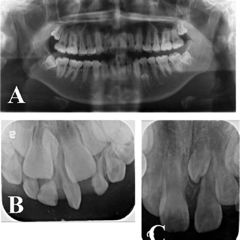 Figure1 Panoramic And Periapical Radiographs Of The Supernumerary Teeth