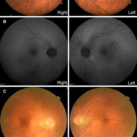 Fundus Photographs Fundus Autofluorescence Faf Images And Optical