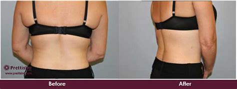 U Lipo® Upper Back Tuck Prettislim Clinic