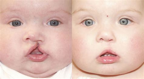 Cleft Lip Surgery Before And After Gallery James P Bradley Md