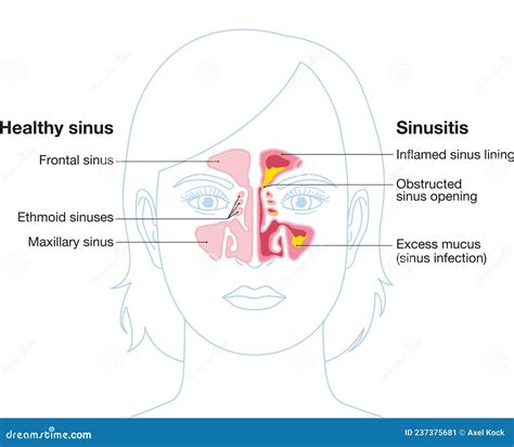 Sinusitis Vector Illustration Labeled Stock Illustration