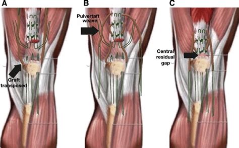 Surgical Treatment Of Chronic Rupture Of The Quadriceps Using A