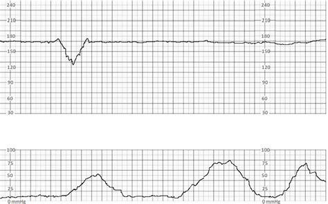 Fetal Monitoring Statpearls Ncbi Bookshelf