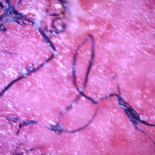 (A) Skin lesions on the hand of a Morgellons disease patient. (B) Skin... | Download Scientific ...