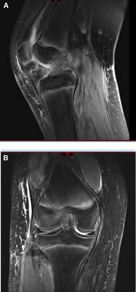 (A) An MRI scan image of the Sagittal side revealed good morphology of ...