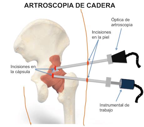 Artroscopia De Cadera Te Lo Cuenta Tu Traumat Logo En Granada