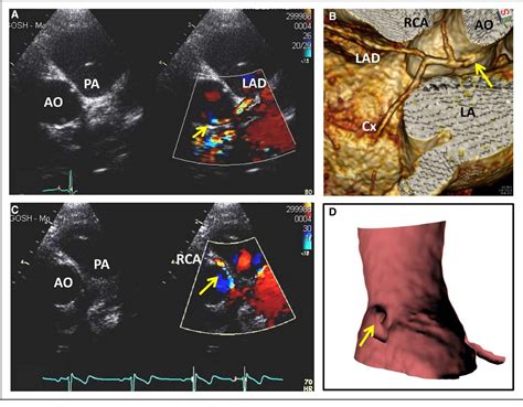 Figure 1 From Value Of Stress Transesophageal Echocardiography In An