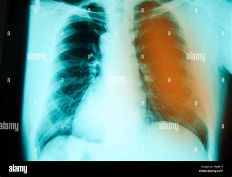 Examen De Radiografía De Tórax Para El Diagnóstico De Infección De