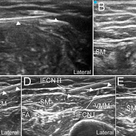 Ultrasound Guided Dye Injection Of The Pp In Cadavers A Dye Injection