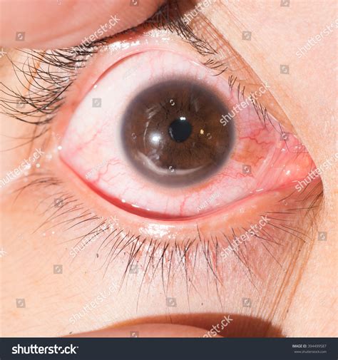 Marginal Keratitis