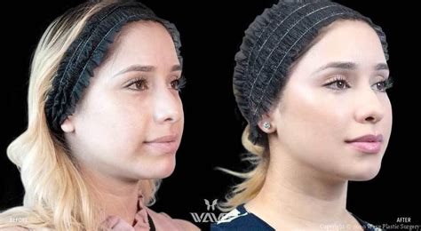 popular facelift alternatives wave