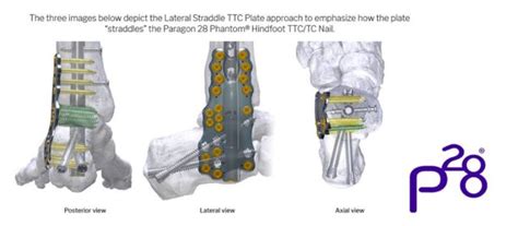 Paragon 28 Inc Increases Its Robust Hindfoot Fusion Plating Offering