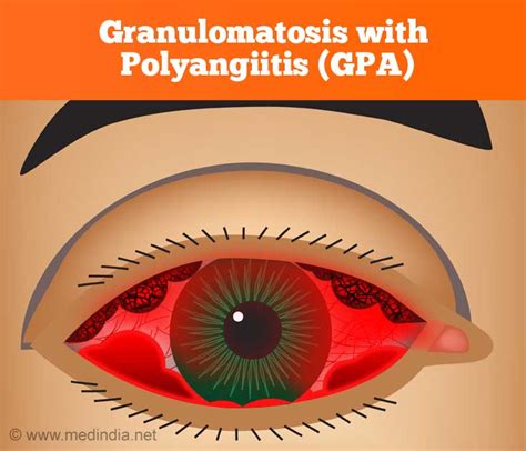 Granulomatosis With Polyangiitis GPA Symptoms Signs Diagnosis