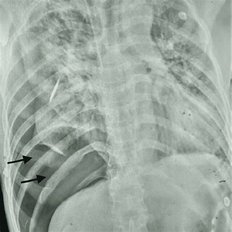 Initial Chest X Ray Showing Right Sided Pneumothorax Black Arrows