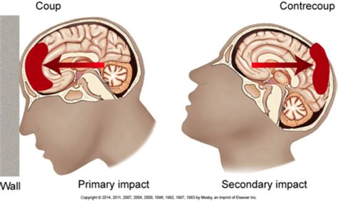 Ch Acute Intracranial Problems Flashcards Quizlet