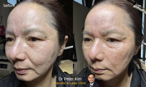 Liquid Face Lift Restore Volume Injection Dr Peter Kim Surgery