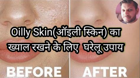 तैलीय त्वचा ऑइली स्किन का ख्याल रखने के लिए 15 घरेलू उपाय Oily Skin