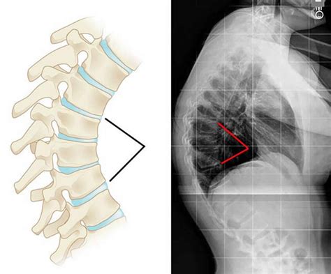 Scheuermann S Disease Causes Symptoms Diagnosis Treatment And Prognosis