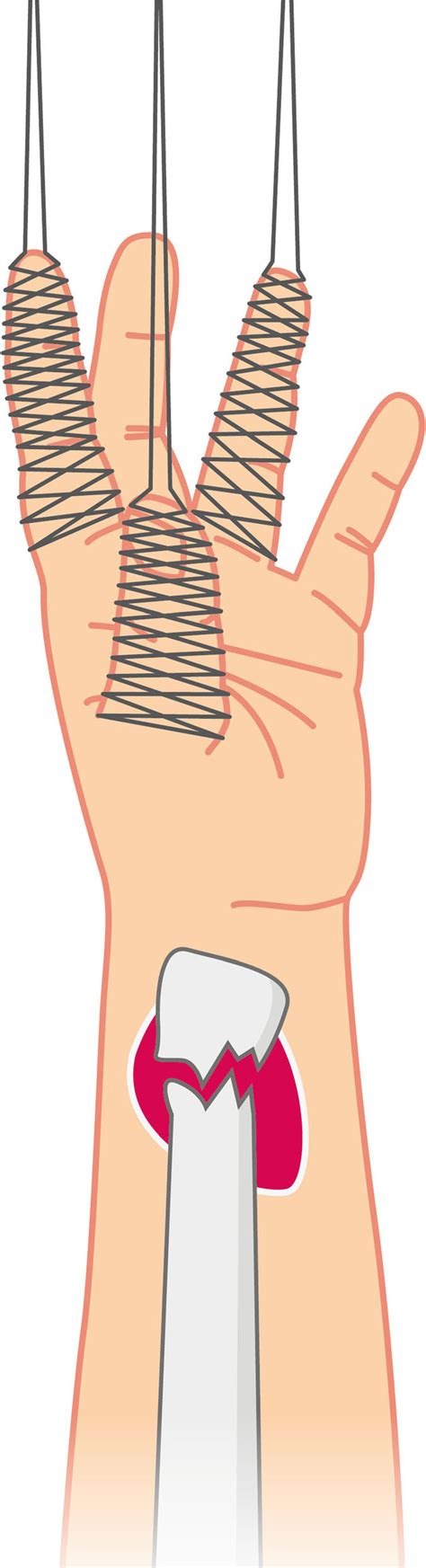 Schematic Of Chinese Finger Trap Traction Applied To A Left Distal