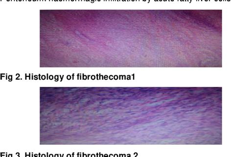 Figure 2 From A Case Report Of Fibrothecoma Semantic Scholar