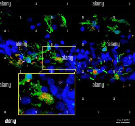 Retinitis pigmentosa Fotos und Bildmaterial in hoher Auflösung Alamy