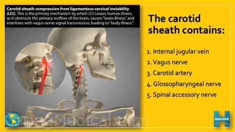 Atlantoaxial Instability