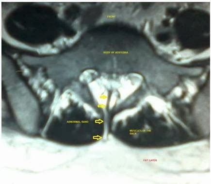 Neurosurgeon India: Limited Dorsal Spinal Rachischisis