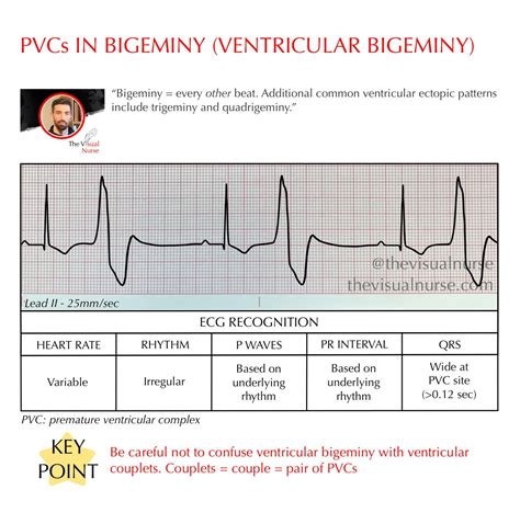 Ventricular Bigeminy PVCs In Bigeminy On ECG For New Nurses And