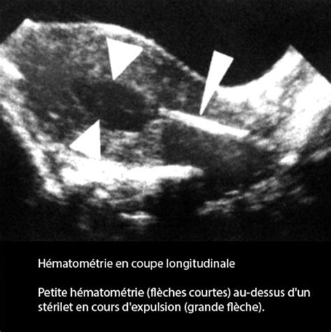 Anomalies De La Cavit Ut Rine Dr Kara Zaitri M A