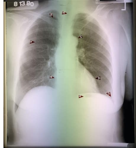 Radiograph B2 Flashcards Quizlet