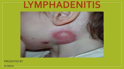 Lymphadenitis | PPT