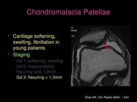 MRI of patellar disorders