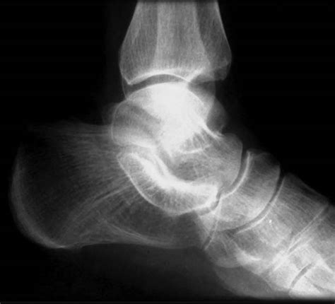 Talocalcaneal Coalition Mri