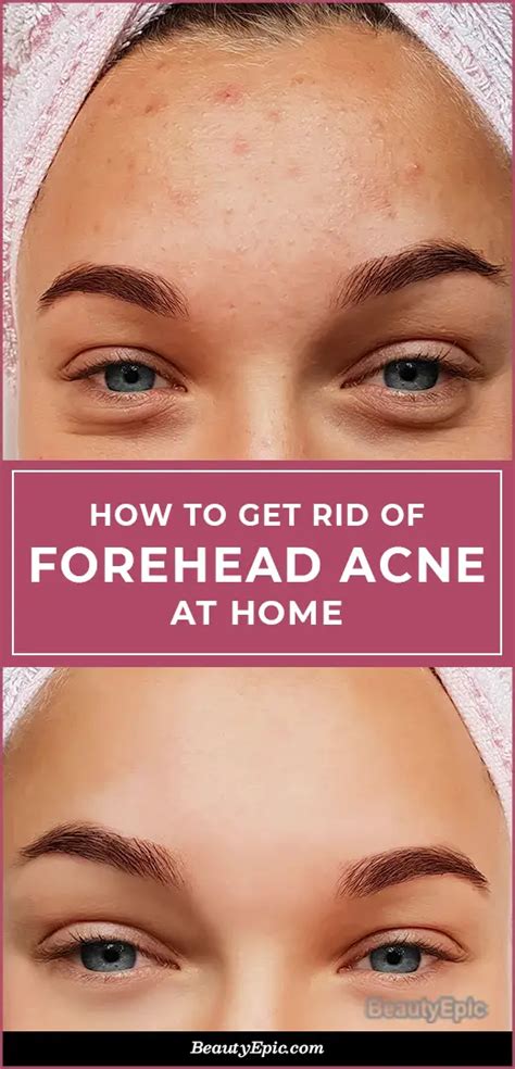 Forehead Acne - Here's How to Treat at Home