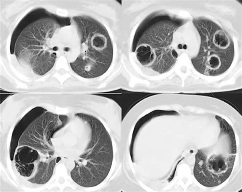 Spiral Ct Scan Of The Chest Showing Several Cavities And Nodules In