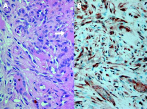 Kaposis Sarcoma Infiltrating Skeletal Muscle Sexually Transmitted