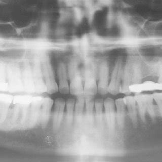 Orthopantomograph Of The Same Patient With No Pathological Finding With