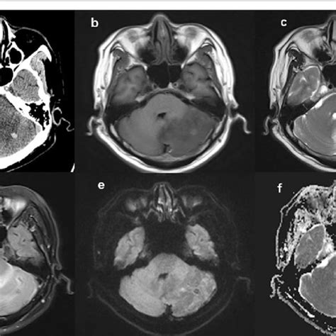 A Ct Imaging Showing A Lesion In The Left Cerebellar Hemisphere With A