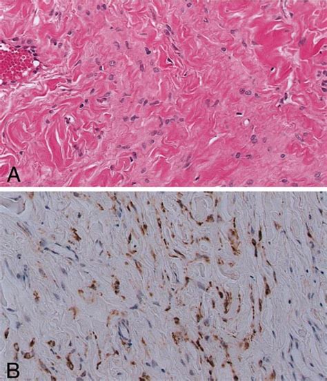 Sclerosing Perineurioma A Epithelioid Or Spindle Shaped Tumor Cells